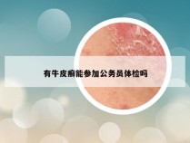 有牛皮癣能参加公务员体检吗