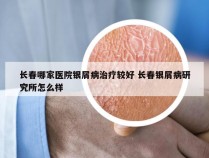 长春哪家医院银屑病治疗较好 长春银屑病研究所怎么样