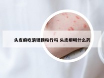 头皮癣吃消银颗粒行吗 头皮癣喝什么药