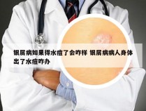 银屑病如果得水痘了会咋样 银屑病病人身体出了水痘咋办