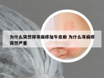 为什么突然得荨麻疹加牛皮癣 为什么荨麻疹突然严重