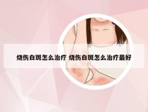 烧伤白斑怎么治疗 烧伤白斑怎么治疗最好