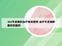 301牛皮癣的治疗相关视频 治疗牛皮病癣最好的医院