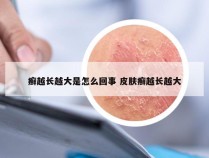 癣越长越大是怎么回事 皮肤癣越长越大