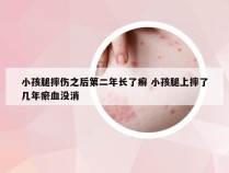 小孩腿摔伤之后第二年长了癣 小孩腿上摔了几年瘀血没消