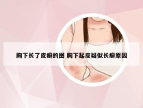 胸下长了皮癣的图 胸下起皮疑似长癣原因