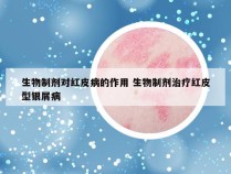 生物制剂对红皮病的作用 生物制剂治疗红皮型银屑病