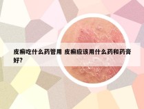 皮癣吃什么药管用 皮癣应该用什么药和药膏好?