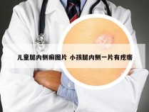 儿童腿内侧癣图片 小孩腿内侧一片有疙瘩