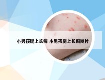 小男孩腿上长癣 小男孩腿上长癣图片