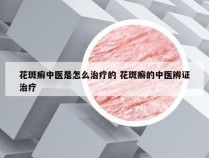 花斑癣中医是怎么治疗的 花斑癣的中医辨证治疗