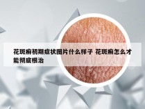 花斑癣初期症状图片什么样子 花斑癣怎么才能彻底根治