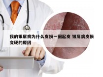 我的银屑病为什么皮损一圈起皮 银屑病皮损变硬的原因