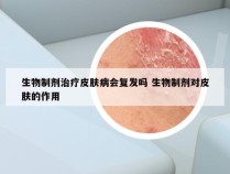 生物制剂治疗皮肤病会复发吗 生物制剂对皮肤的作用