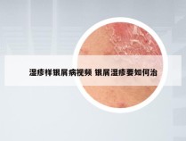 湿疹样银屑病视频 银屑湿疹要如何治