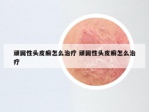 顽固性头皮癣怎么治疗 顽固性头皮癣怎么治疗