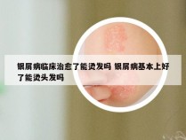 银屑病临床治愈了能烫发吗 银屑病基本上好了能烫头发吗