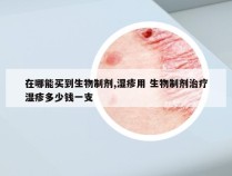 在哪能买到生物制剂,湿疹用 生物制剂治疗湿疹多少钱一支