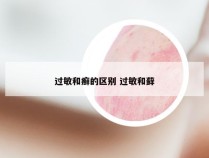 过敏和癣的区别 过敏和藓