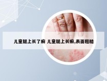 儿童腿上长了癣 儿童腿上长癣,表面粗糙