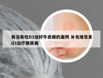 有没有吃D3治好牛皮癣的案例 补充维生素d3治疗银屑病