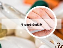 牛皮癣变成暗红色