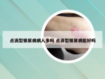 点滴型银屑病病人多吗 点滴型银屑病能好吗