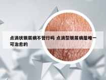 点滴状银屑病不管行吗 点滴型银屑病是唯一可治愈的