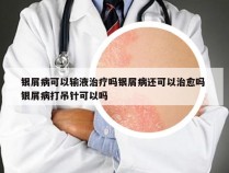 银屑病可以输液治疗吗银屑病还可以治愈吗 银屑病打吊针可以吗