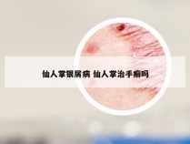 仙人掌银屑病 仙人掌治手癣吗