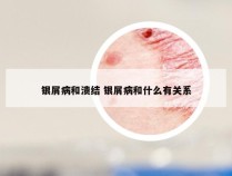 银屑病和溃结 银屑病和什么有关系