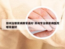 郑州治银屑病那家最好 郑州专治银屑病医院哪家最好