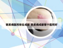 银屑病医院排名成都 银屑病成都那个医院好