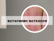 唯达宁治疗癣的图片 唯达宁乳膏的作用