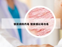 银屑病和丹毒 银屑病以毒攻毒