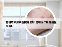 昆明市银屑病医院哪里好 昆明治疗银屑病医院最好