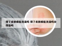 得了皮肤癣能洗澡吗 得了皮肤癣能洗澡吗会传染吗