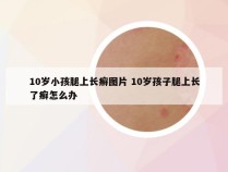 10岁小孩腿上长癣图片 10岁孩子腿上长了癣怎么办