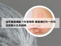 治疗银屑病能一针见效吗 银屑病打针一针可以控制十几年的吗