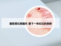 胳肢窝红癣图片 腋下一块红红的像癣