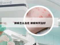 脚癣怎么治愈 脚癣如何治好