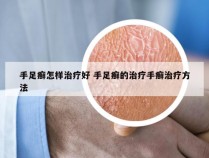 手足癣怎样治疗好 手足癣的治疗手癣治疗方法