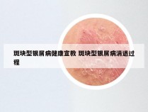 斑块型银屑病健康宣教 斑块型银屑病消退过程