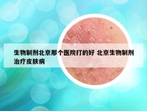 生物制剂北京那个医院打的好 北京生物制剂治疗皮肤病