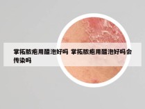 掌拓脓疱用醋泡好吗 掌拓脓疱用醋泡好吗会传染吗