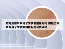 脓疱型银屑病用了生物制剂能好吗 脓疱型银屑病用了生物制剂能好吗会传染吗