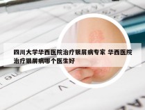 四川大学华西医院治疗银屑病专家 华西医院治疗银屑病哪个医生好