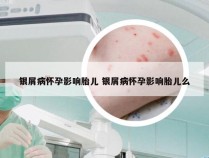 银屑病怀孕影响胎儿 银屑病怀孕影响胎儿么