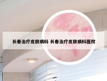 长春治疗皮肤病科 长春治疗皮肤病科医院