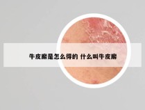 牛皮廨是怎么得的 什么叫牛皮廨